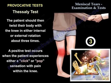 special tests for meniscus tear|meniscus tear tests self.